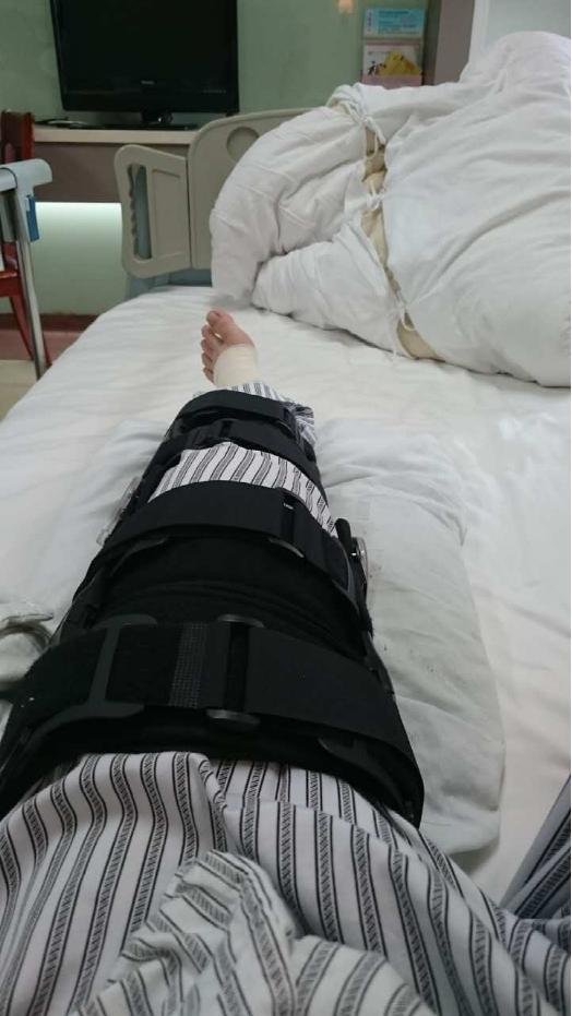 【叉友投稿】ACL术后心得——18岁生日前几天断叉