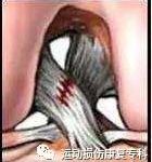 前交叉韧带损伤等级评估与相应治疗-前叉之家