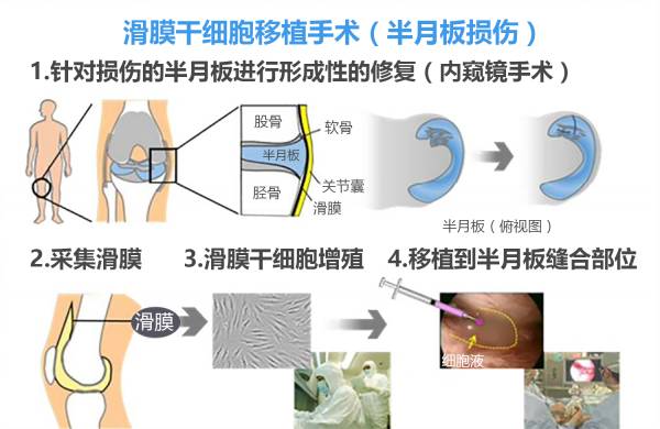 谁看谁想赞 半月板再生手术 日本已开始临床实验 前叉之家