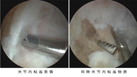 关节镜下的粘连