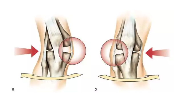 膝关节内侧副韧带损伤示例