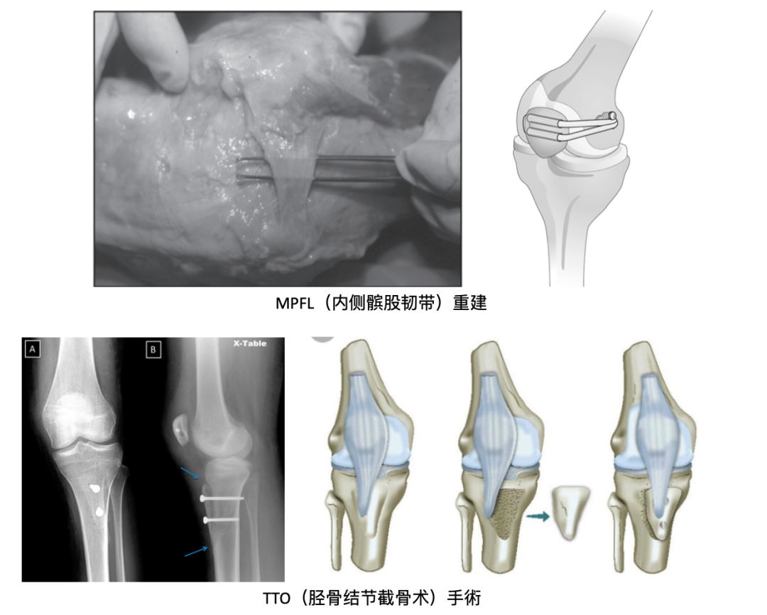 髌骨脱位示意图图片