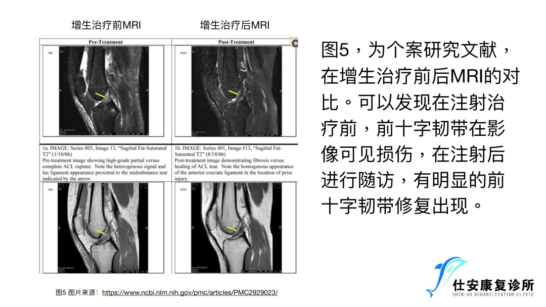 增⽣疗法在前交叉韧带损伤康复中的运⽤ - 为什么可以用增生疗法来治疗前交叉韧带损伤的问题？