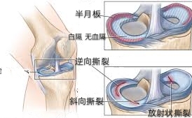 半月板撕裂有哪些？