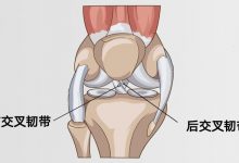 前交叉韧带/后交叉韧带损伤原因-前叉之家