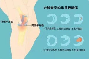 半月板损伤是什么样的 前叉之家