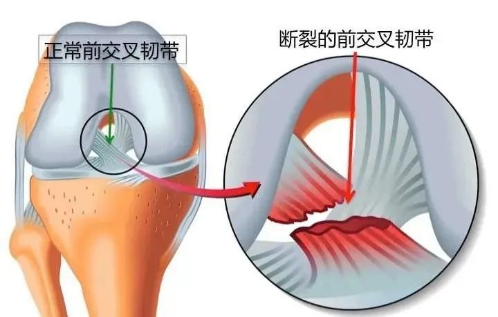 如何预防膝关节前交叉韧带损伤？