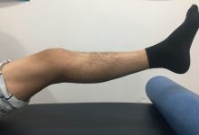 前叉术后伸直要练到过伸吗?如何判断有没有伸直?-前叉之家