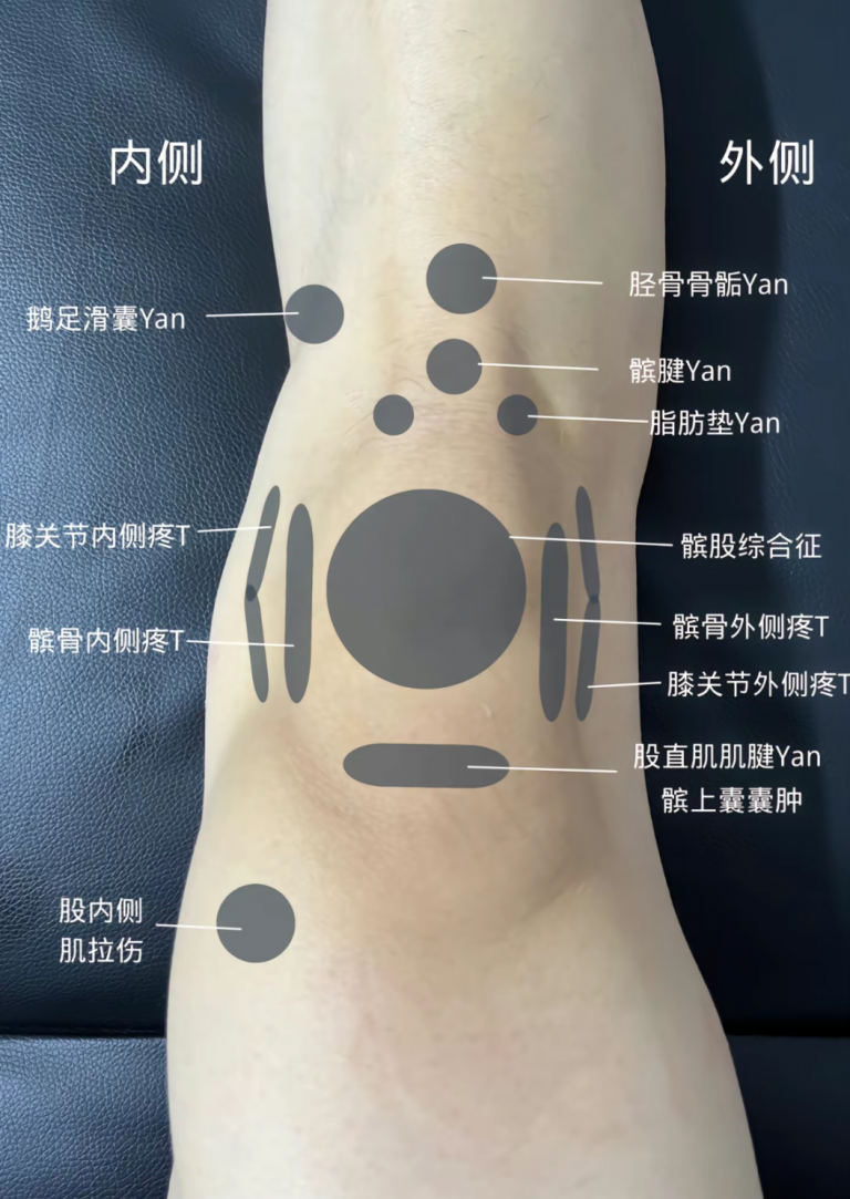 【疼痛位置图】一文判断膝关节疼痛 | 前叉之家