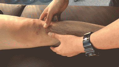 疤痕松解.gif