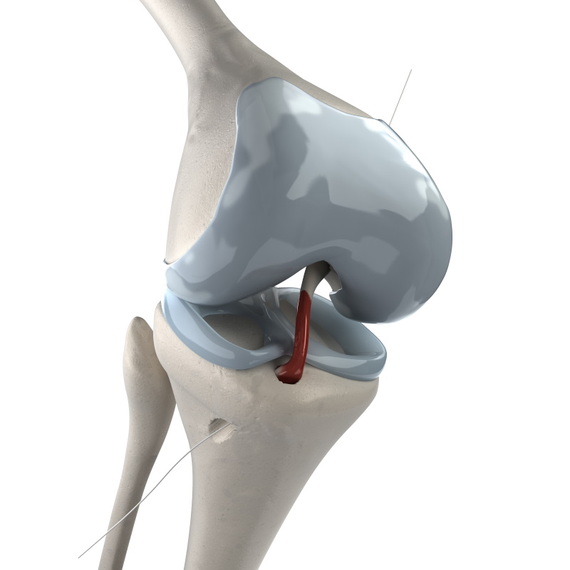 Anterior Cruciate Ligament (ACL) Injury