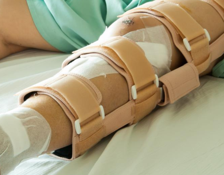 Leg Fracture Surgery in Quezon City - Tec Orthopedics
