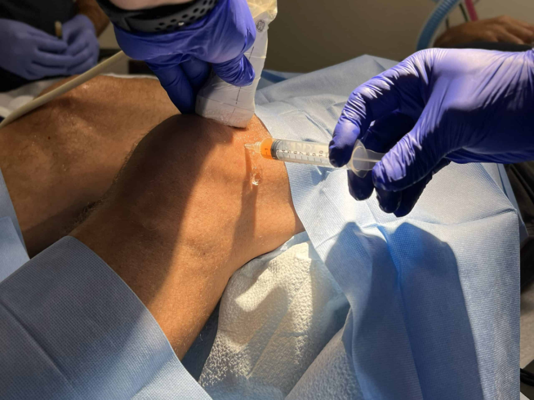 CAN AN INJECTION SAVE A PATIENT FROM ACL SURGERY? | Regenexx® at New Regeneration Orthopedics
