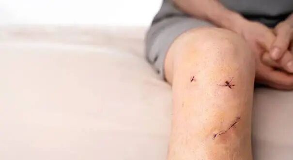 ECU | ECU research uncovers why some athletes struggle to bounce back after ACL  surgery