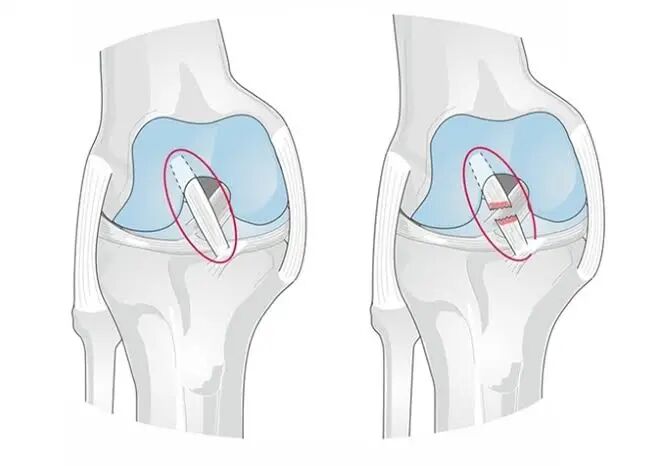 Anterior Cruciate Ligament (ACL) Injury